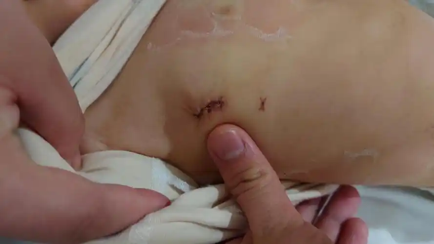 常见先心病-室间隔缺损_室间隔缺损_介绍_症状表现_治疗方式 - 好大夫