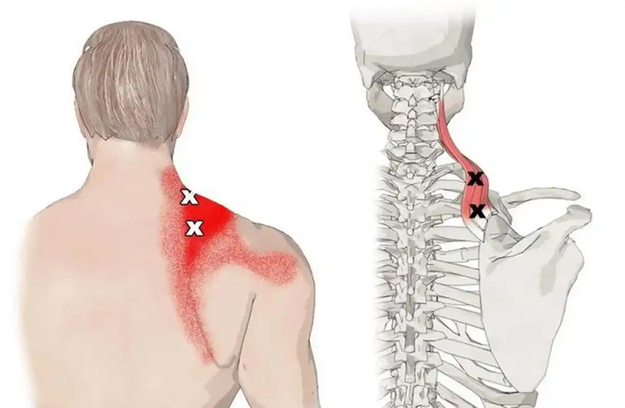 两个常见原因  [大哭] 1,能找到痛点——肌肉受损 如果你觉得肩胛骨缝