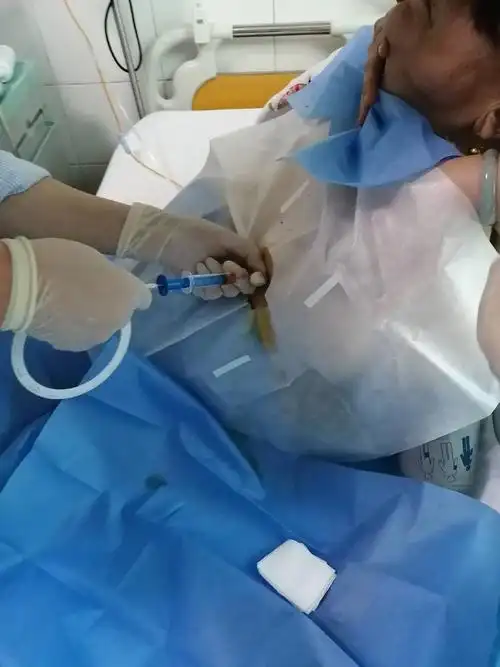 心包填塞,一针穿刺救命 - 美篇