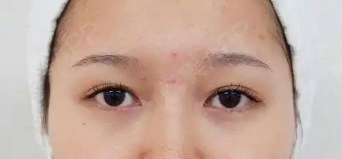 埋线双眼皮术后17天_全切双眼皮术后17天_双眼皮术后17天_眼部整形术