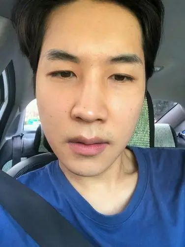 手术前,鼻孔外翻,鼻梁低,咨询的时候院长说明的很详_圈子-新氧美容