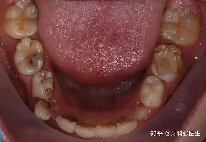 牙齿是如何一步步被我们拖坏的