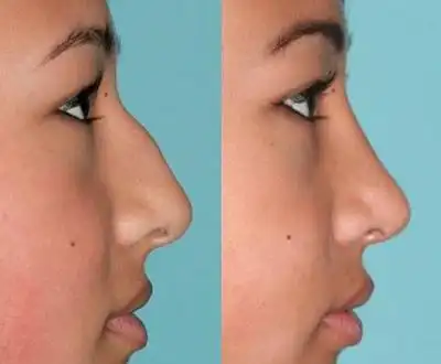 驼峰矫正侧面看改善效果明显鼻梁线条顺滑流畅,而且还有着女性特色的