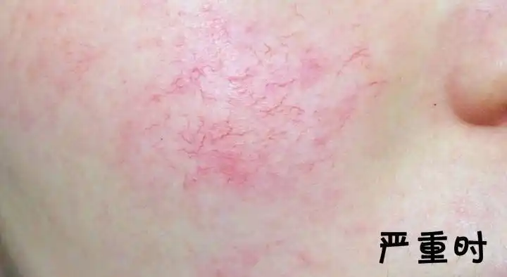 绵竹医而美朱华院长怎样告别红血丝脸蛋