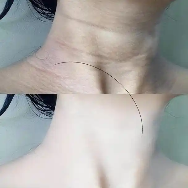 颈部细纹很显老,想要淡化颈部细纹有很多方法,能使皮肤恢复青春