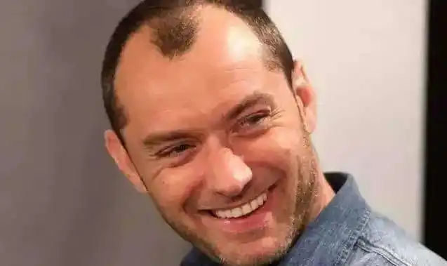 出现m型脱发的原因,m型脱发还有救吗?