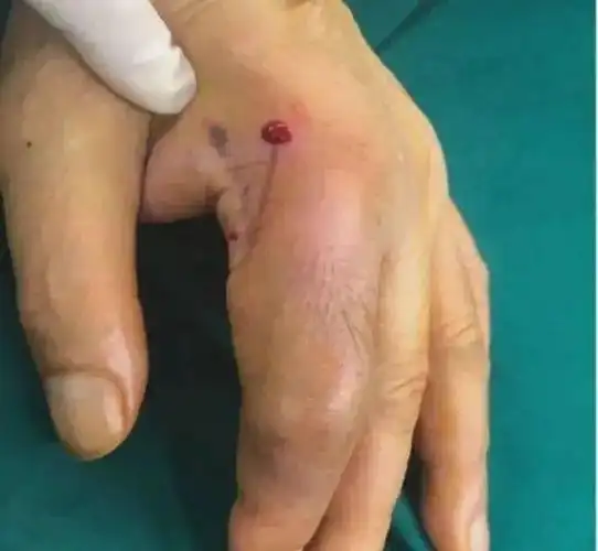 吓坏湖南男子脚跟被铁钉刺伤被他这样处理后差点要截肢
