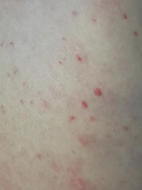 干燥综合征皮疹