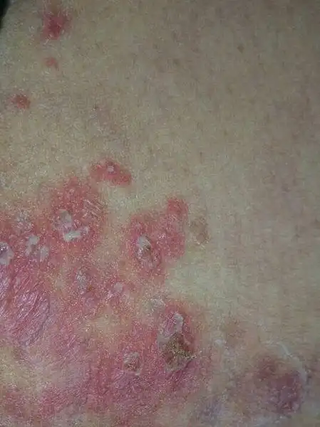 问:皮肤病,10号早上发现大腿根有红色带白色的水泡,很疼,不痒.