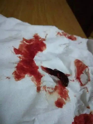 经常排卵期出血是怎么回事 详解导致排卵期出血的5大原因