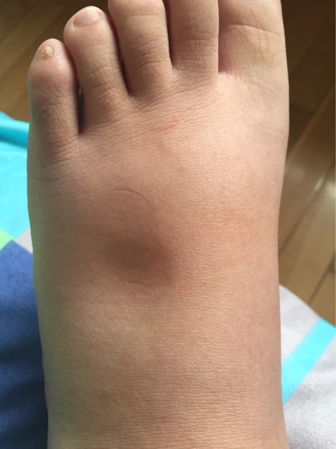 脚肿,脚底板不敢挨地,走路一瘸一拐