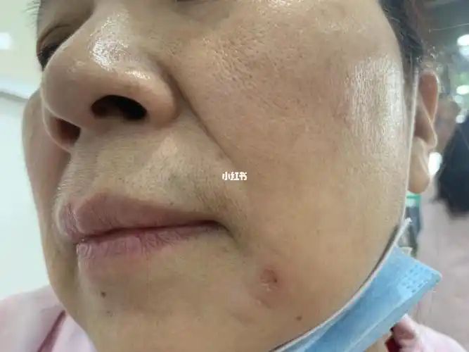 珀芙研 一两周之前,我本身皮肤就比较敏感脆弱,皮肤感觉非常瘙痒_修复