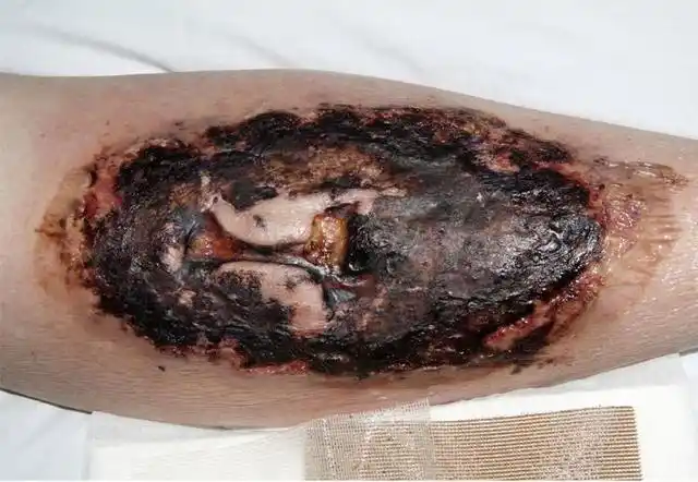 警惕,外伤后溃疡一定是感染吗?