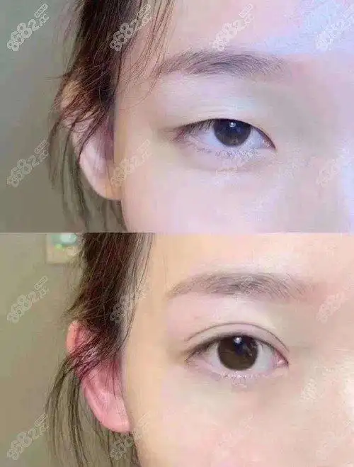 杭州美莱高士乾双眼皮对比案例图 图源www.8682.cc