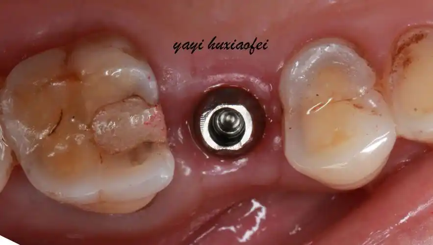 青年牙医胡医生种植牙病例分享