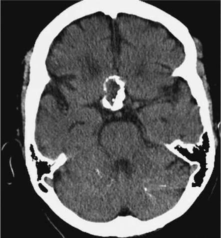 轴位平扫ct显示鞍上区肿物伴钙化,与颅咽管瘤表现一致.