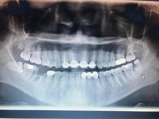 左下第三磨牙龋坏需拔除