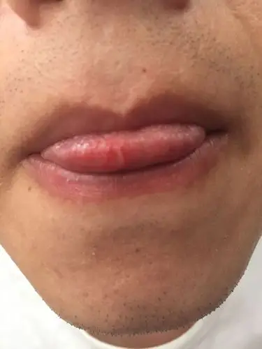 最近一个月来舌头上老是长一颗溃疡,好了没过两三天又接着长一颗.