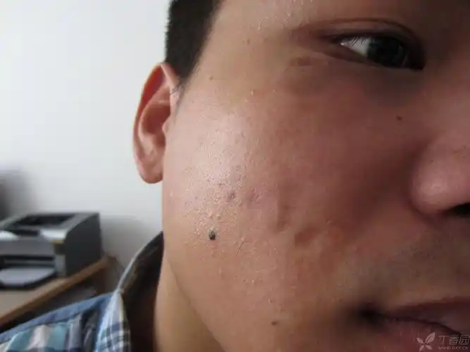 【病例讨论】面部萎缩性皮损-疑难讨论 - 皮肤与性传播疾病讨论版