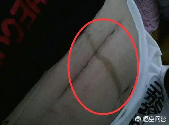 孕肚 黑线 产后 消失 第2张