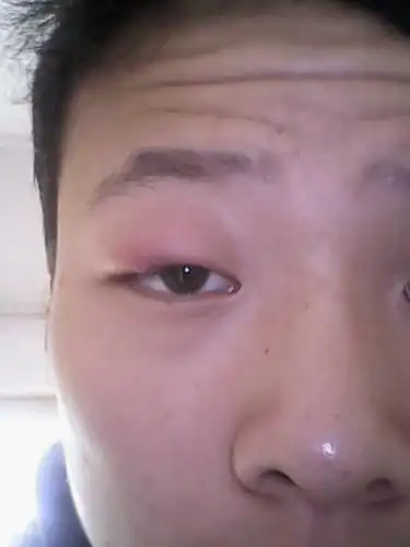 眼睛肿成这样,怎么回事啊