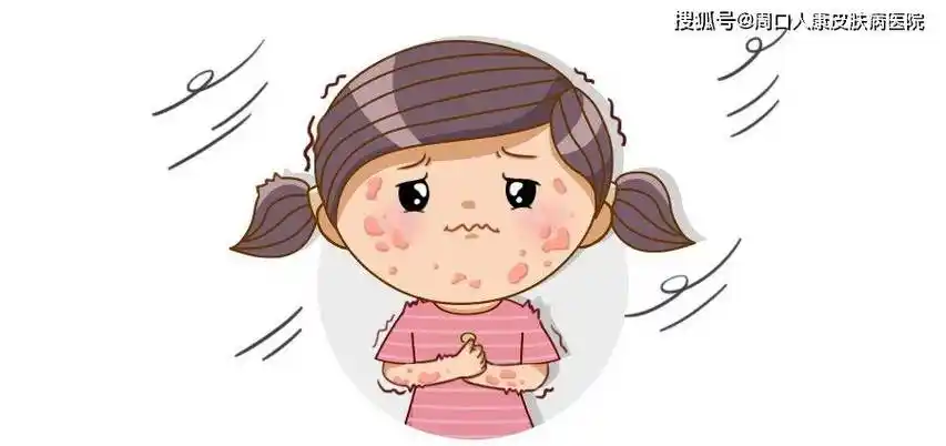 【周口人康皮肤病医院】如何识别和处理儿童荨麻疹?