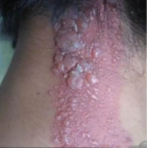 假尖锐湿疣早期图片