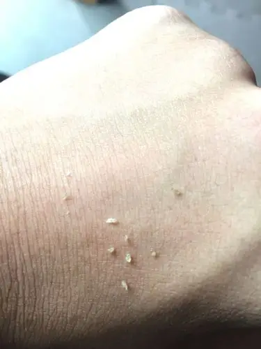 这个从脸上挤出来的是什么?为什么会有这个?有什么影响吗?