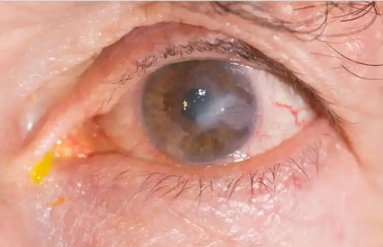 角膜炎的四大症状,发现立即就医!-找薛医生在线问诊