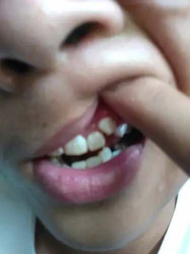 我的虎牙长在牙龈上面了,而且牙齿都不齐,这该怎么办啊?