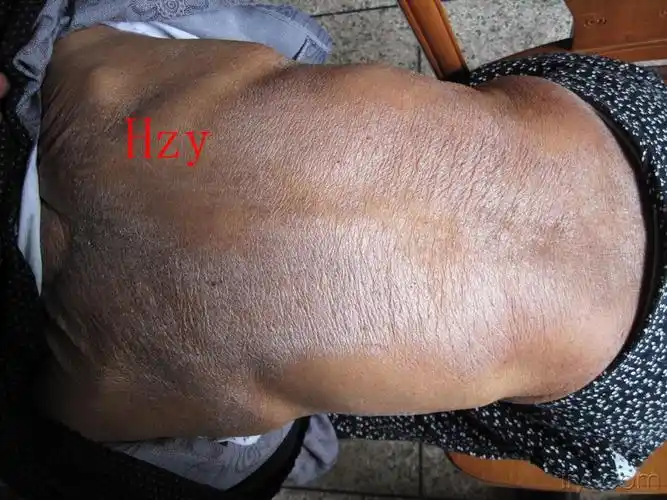 公布答案:老年性皮炎瘙痒症 - 皮肤及性传播疾病讨论版 - 爱爱医医学