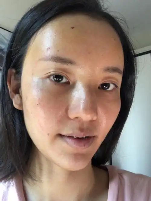 术后第三天,脸上油光满面的这三天都没有碰水洗脸.