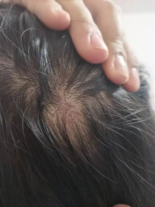 自从用了从淘宝上买的巴黎欧莱雅的洗头膏后头皮上就长了痘痘,最主要_