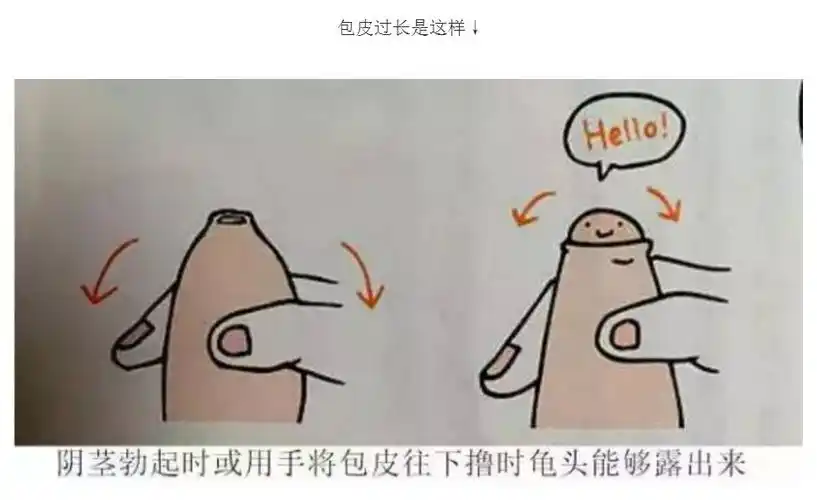 小包皮,大问题?都需要割吗?