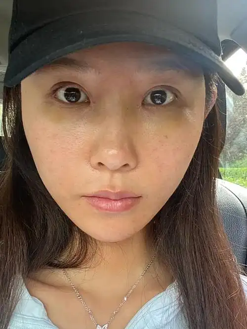 诊断:求美者肤色暗沉偏黑黄,面部无光泽,轻微小细纹,皮肤干燥,出油