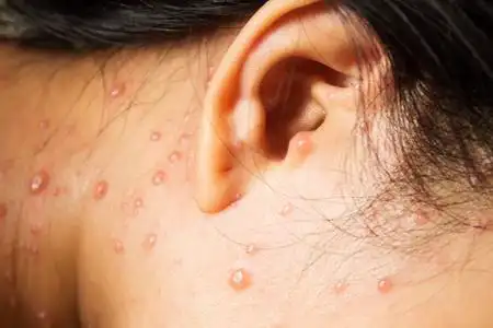 脸上的水痘照片