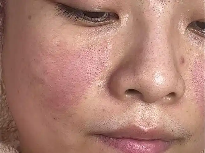 大油皮还屏障受损发红,我们挑战一下90天能不能给他拿下