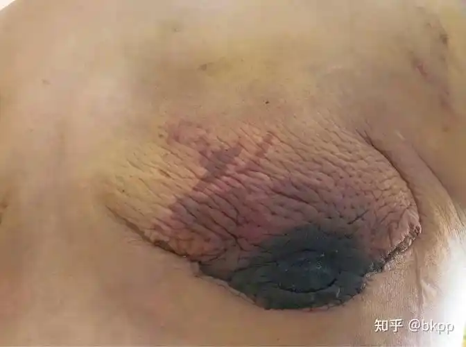 说伤口还没有长好,还有一个医生问我是不是在地下诊所做得手术?