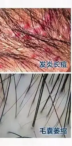 引发头皮毛囊炎的主要原因