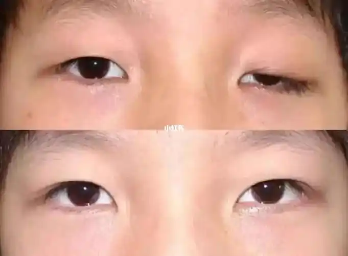 重症肌无力的眼睑下垂和复视