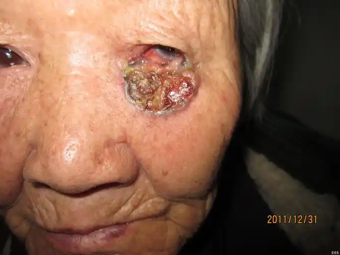 下眼睑皮肤反复溃疡5年