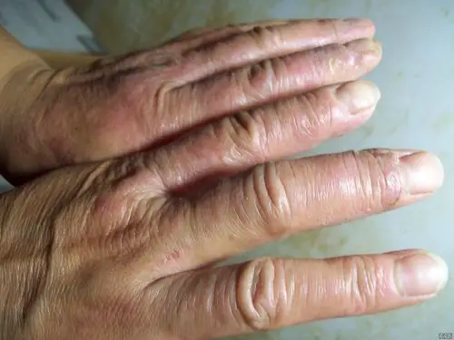 这个手癣怎么这么难治本帖因图片太大关闭请学习版规后在发帖良版44