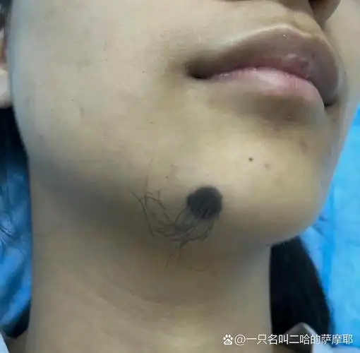 长毛是好还是坏下巴痣上长毛下巴有痣图解下巴下面有点可以去除吗痣