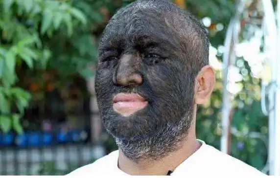 世界上毛发最多的男人满脸都是黑毛如今已结婚生子