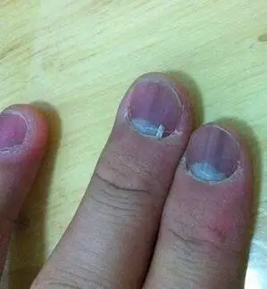 肝脏不好的人,手指甲会有什么不一样?