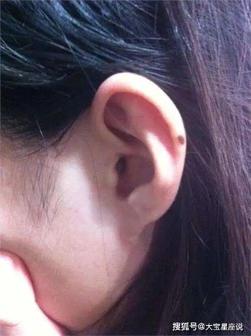 原创女人这几个地方长痣是福气的象征, 千万不要想着点掉!