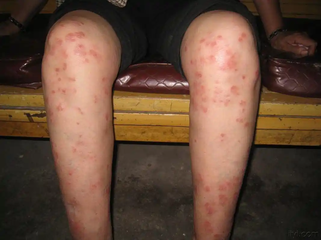 大家看下这是什么皮肤病?