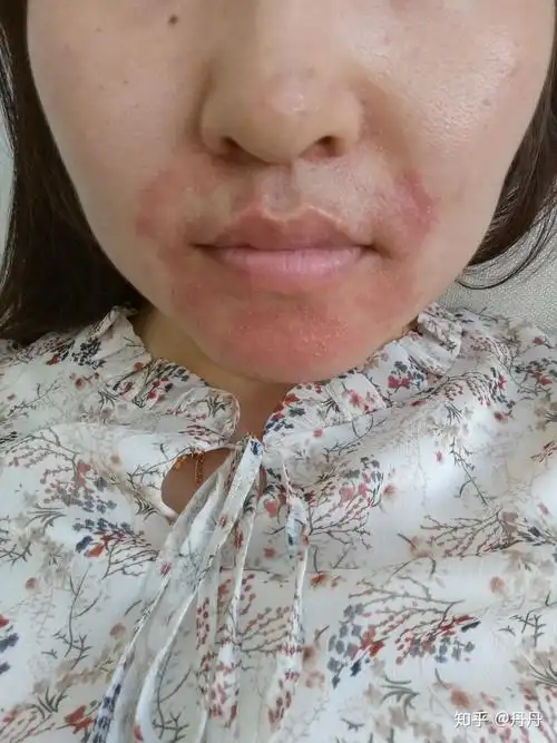 如何治疗面部脂溢性皮炎,困扰我n年了,求各位大神给我一些能彻底治疗