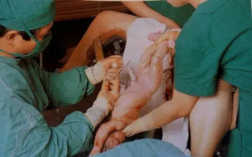 孕妇生孩子全过程|真人图-母婴频道-手机搜狐