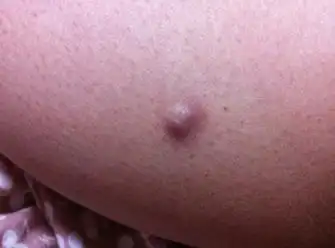 腿上长了个东西越来越大了,不痒不痛,是什么啊?要怎么处理啊.看照片.